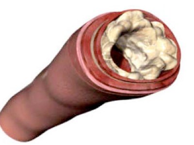 Unclog your arteries by eating right